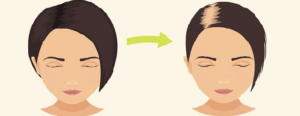 Thay đổi nội tiết là một trong những nguyên nhân phổ biến gây rụng tóc 