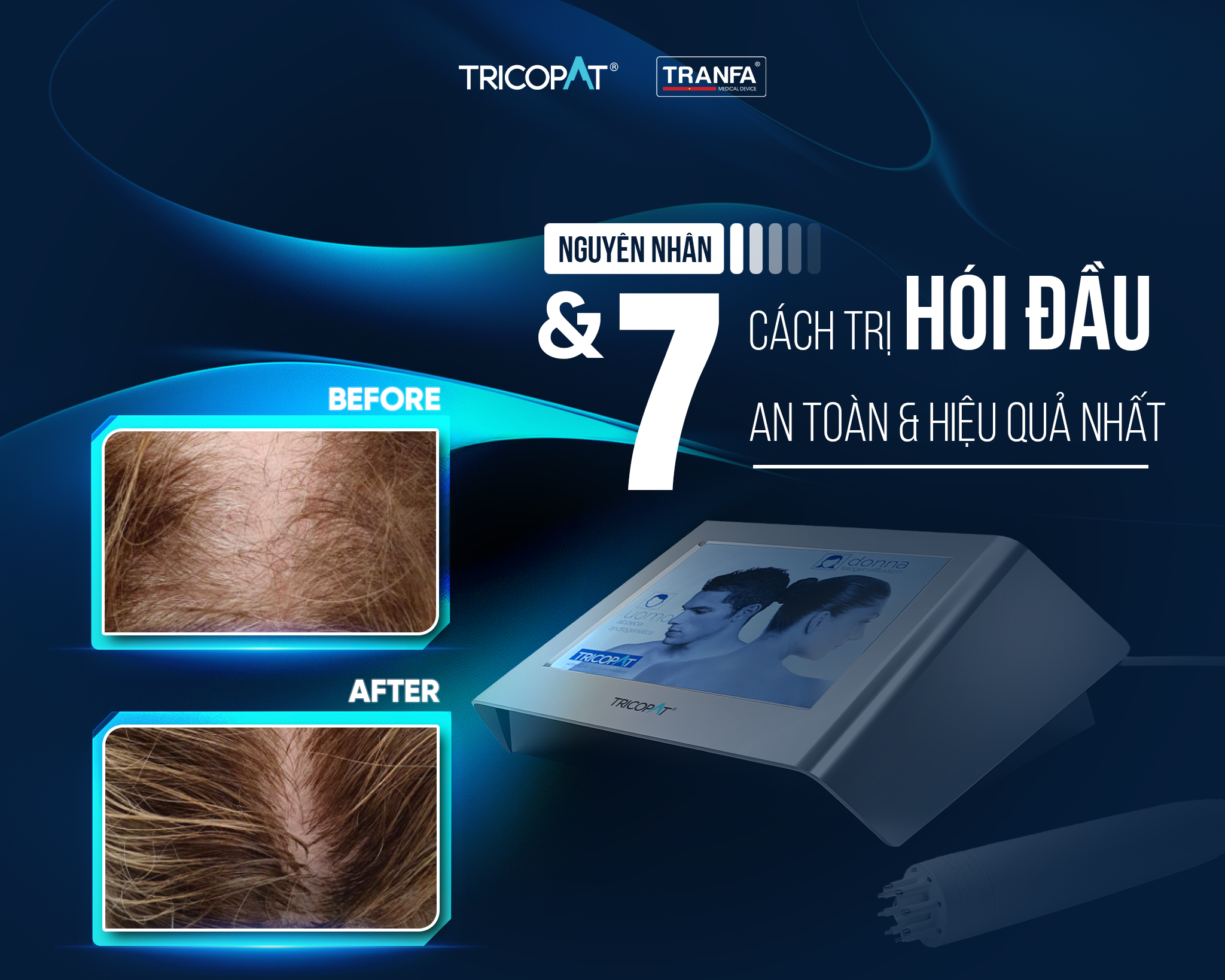 Nguyên nhân hói đầu: 7 Cách trị hói đầu an toàn & hiệu quả nhất