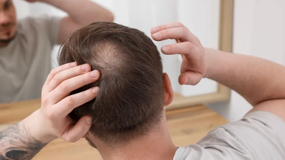 Hói đầu – Vấn đề không của riêng ai (Cách trị hói đầu)